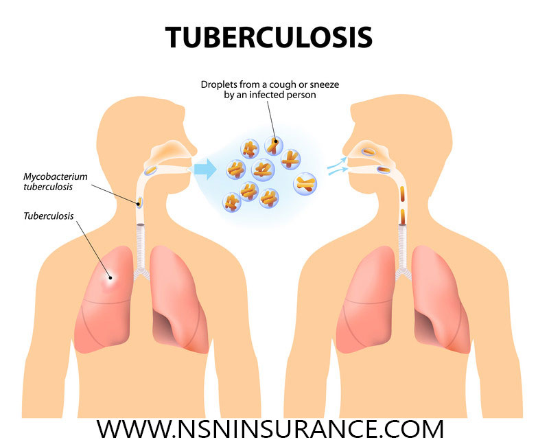 Gejala Tuberkulosis
